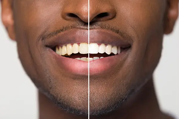 Tooth Whitening